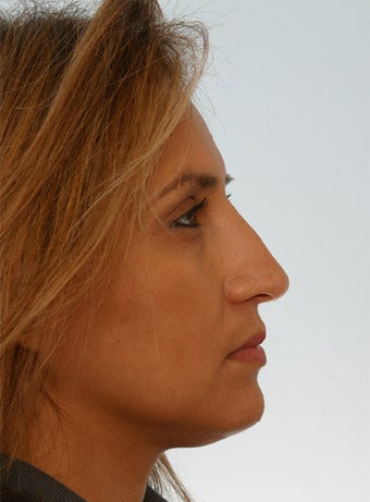 Non Surgical Rhinoplasty Juvederm Ultra Plus after 260324
