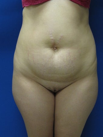 Abdominoplasty before 343059