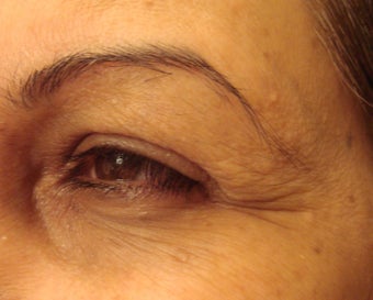 botox injections before 263048