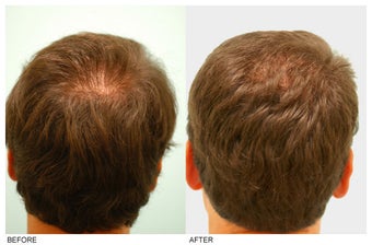 Crown (Vertex) Hair Transplant before 134767