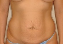 Abdominoplasty with Lipoabdominoplasty technique before 247247