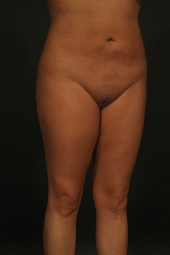 Liposuction 315578