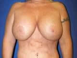 Breast Augmentation Surgery with Saline Implants (Overfill) before 149643