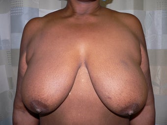 Breast reduction using the Ultimate Lift technique before 360399