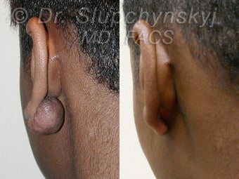 Keloid Removal before 613838