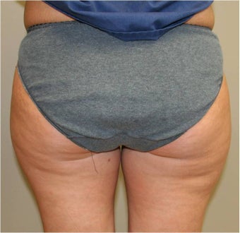 Smart Lipo Saddlebags (moderate) Posterior View before 109416