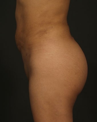 Brazilian Butt Lift after 271526