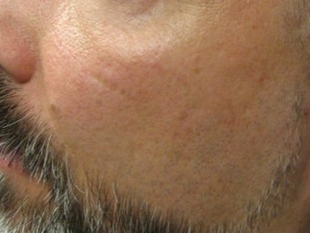 CO2 Fractionated Laser Resurfacing. after 272014