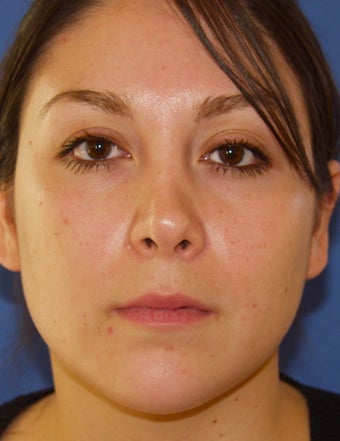 Revision Rhinoplasty before 410615