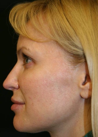 Sculptra after 137167