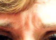 Botox before 341047