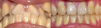 orthodontic treatment before 300716