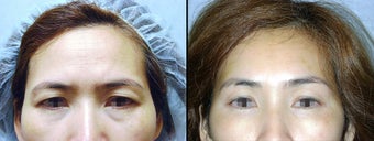 Endoscopic Brow Lift before 649398