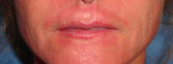 Lip Lift after 624725