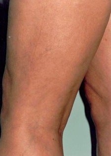 Sclerotherapy after 370422