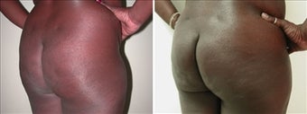 Buttock Augmentation before 110110