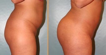 Brazilian Butt Lift before 192134