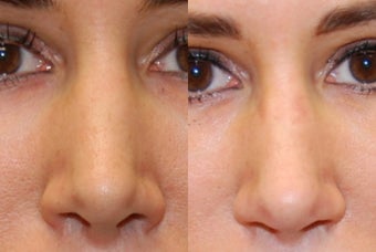 Non-Surgical Rhinoplasty with Silikon-1000 before 287447