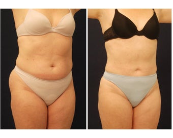 Liposuction before 286731