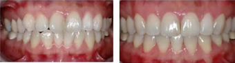Orthodontic Braces - Crooked Teeth before 299206