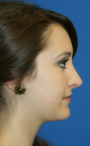 Rhinoplasty after 222677