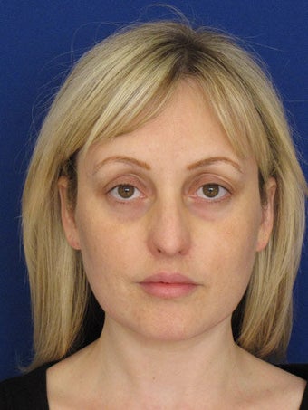 Bilateral Upper Blepharoplasty and Lower Blepharoplasty with TCA Chemical Peel, performed in the office under oral sedation wi before 249704