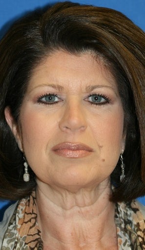 Facelift before 385708