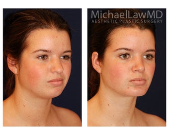 Chin Liposuction after 494435