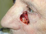 Eyelid and cheek skin cancer reconstruction before 84507
