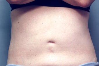 Slim Lipo after 137503