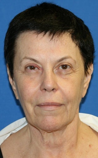 Facelift with Extended Necklift, Browlift, Fat Transfer, Upper Blepharoplasty, and Skin Pinch before 625450