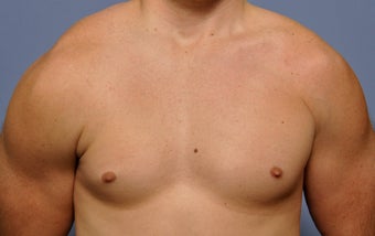 Pectoral Implants before 536031