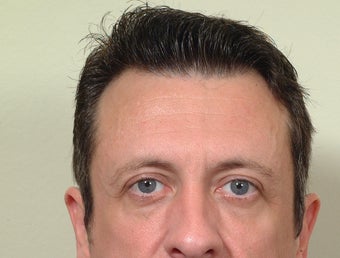 Cheek implants before 110408