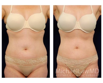 Liposuction before 397198