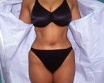 Tummy Tuck before 542650