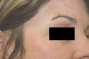 Crow's feet treatment after 88219