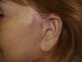 Scar and Earlobe Repair after 333694