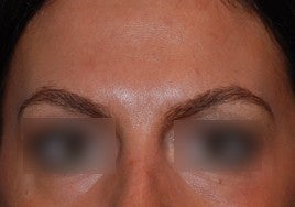 Botox after 555510