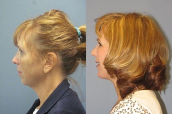 Lite Lift, Chin augmentation, liposuction of the neck after 523354