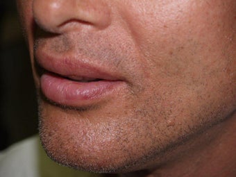 Lip Augmentation after 213005