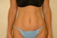 Full Lipoabdominoplasty before 133264