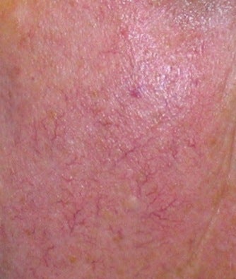 Laser vein treatment before 374353