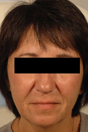 Juvederm for laugh lines before 199421