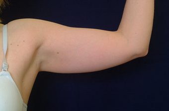 Arm Lift before 149350