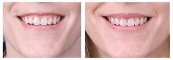Alloderm facial implants for lip augmentation before 6771