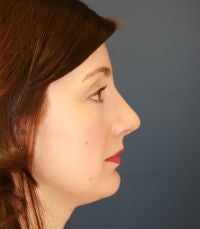 Rhinoplasty (nose reshaping) after 272586