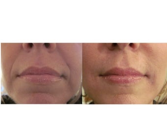 Juvederm Ultra XC & Ultra Plus XC before 359465