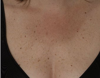 Laser treatment for sun damage before 123342