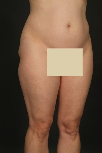 Tummy tuck with hip liposuction before 163042