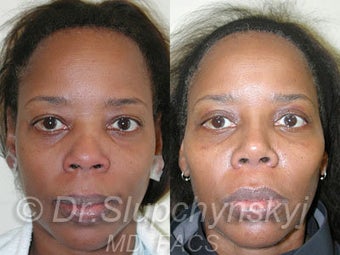 African American Rhinoplasty before 525625